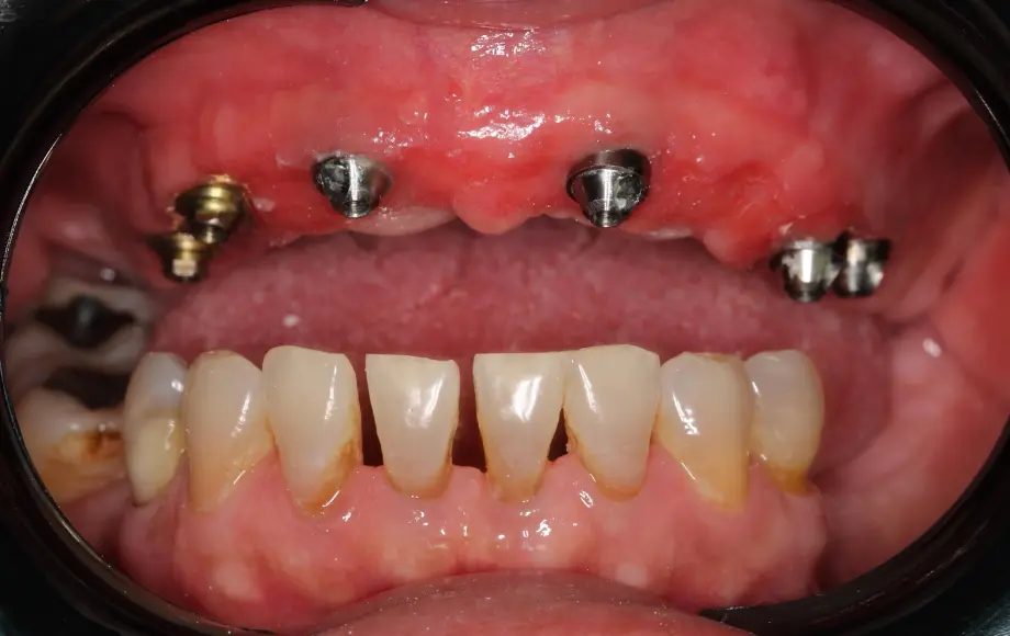 Antes